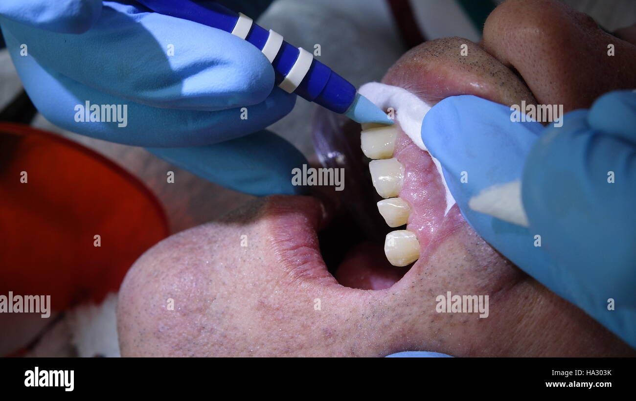 Zahnreinigung und Zahnmedizin Stockfoto