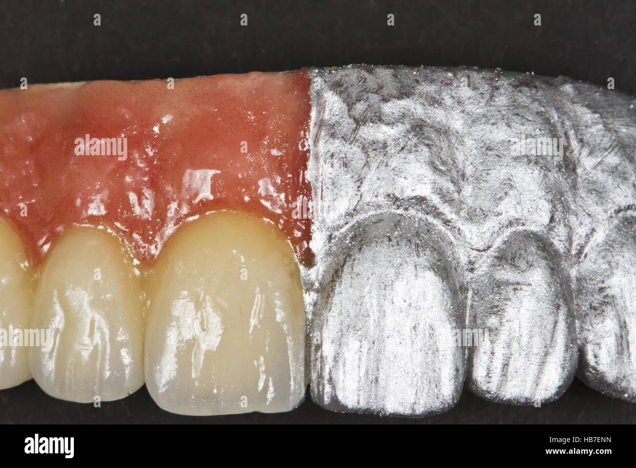 -RNA Keramik vorderen Zähne und Zahnfleisch Stockfoto