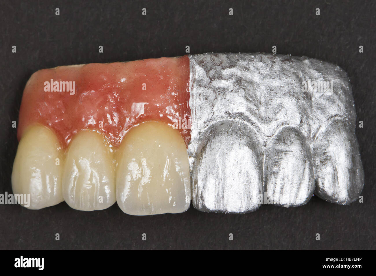 -RNA Keramik vorderen Zähne und Zahnfleisch Stockfoto