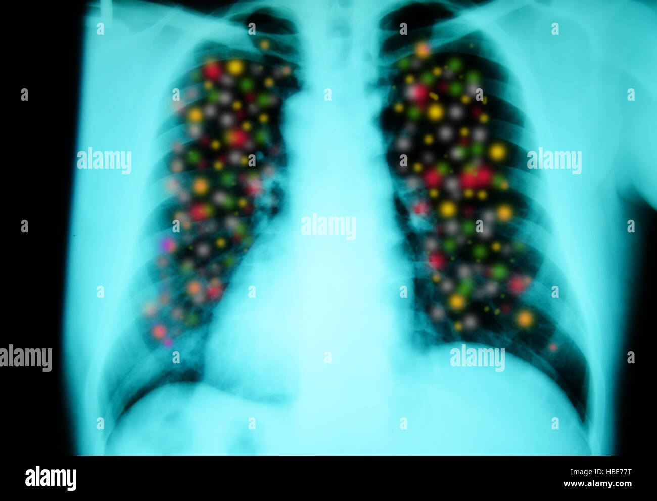 Röntgenuntersuchung der Brust für die Diagnose mit mehrfarbigen Punkt entzündliche Stockfoto