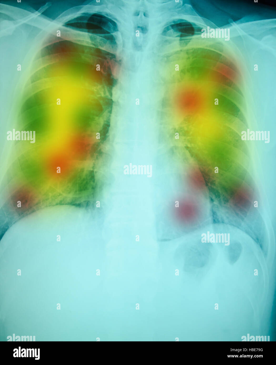 Röntgenuntersuchung der Brust für die Diagnose mit gelben Punkt entzündliche Stockfoto