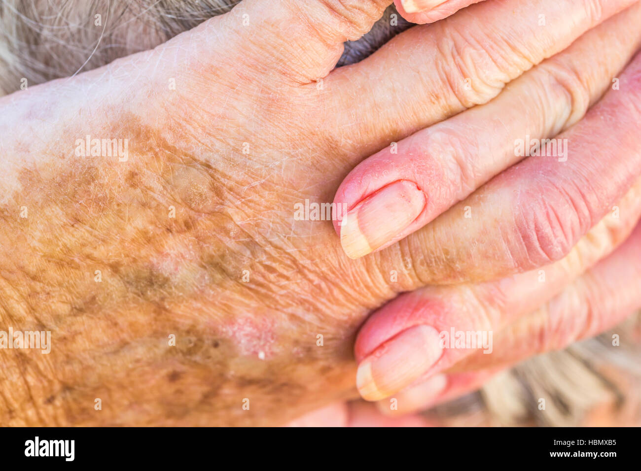 Händen der alten Frau mit Hautproblemen Stockfoto