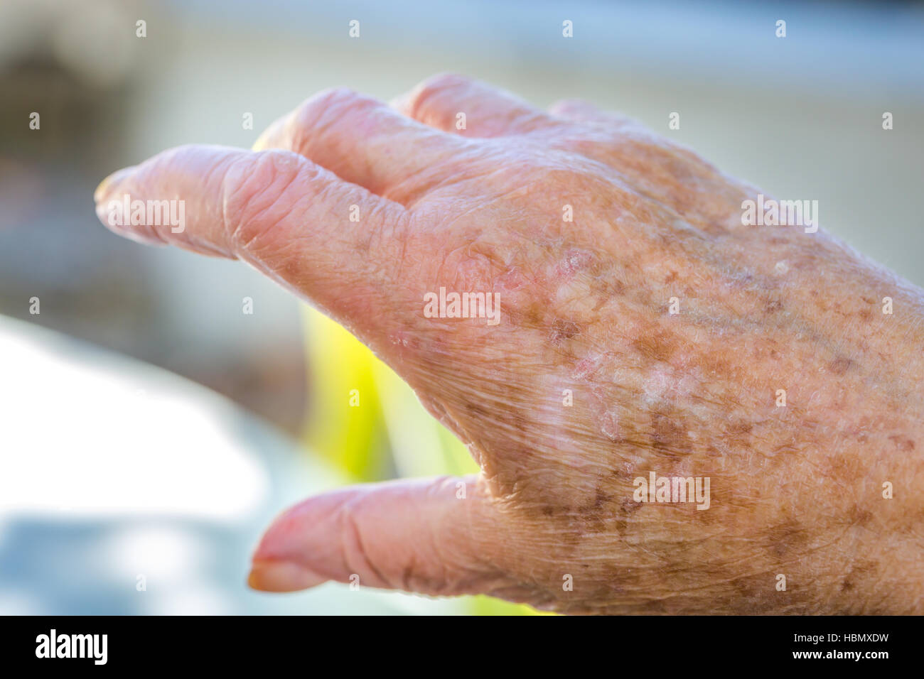 Händen der alten Frau mit Hautproblemen Stockfoto