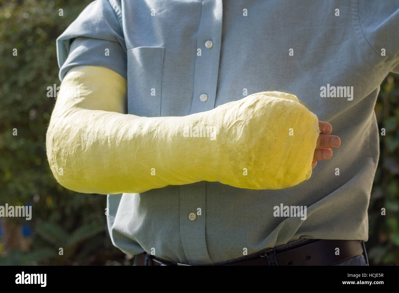 Ein Arm und Ellenbogen in einem gelben Pflaster / Fiberglas gegossen getragen von einem jungen Mann stehend in einem Garten Stockfoto