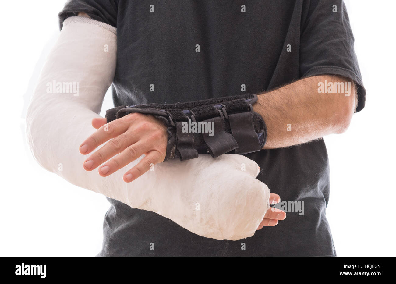 Junger Mann mit weißen langen Arm Putz / Fiberglas gegossen auf einem Arm und Handgelenk und Daumen Schiene auf der anderen, nach einem Unfall, isoliert auf weiss Stockfoto