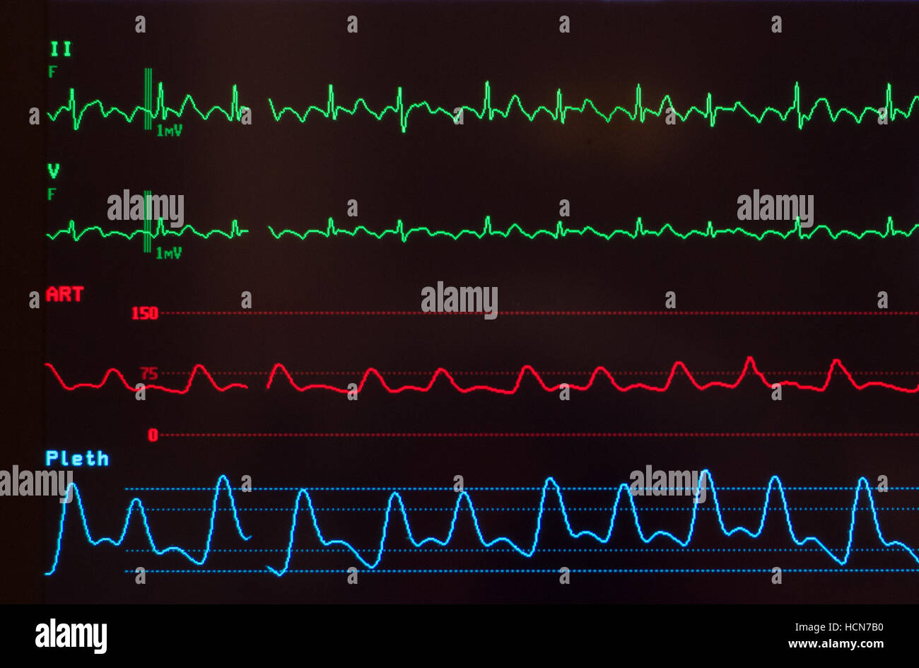 Nahaufnahme von medizinischer Monitor mit EKG mit Vorhofflimmern flattern, arterieller Blutdruck Welle und Sauerstoff Sättigung Niveau gegen Schwarz Stockfoto