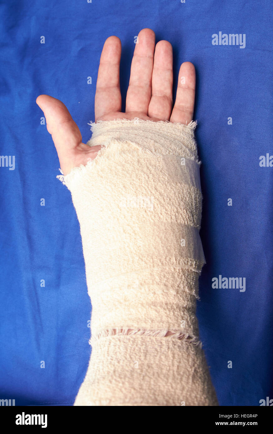 bandagierte linke Hand nach Verletzungen Karpaltunnel-Operation Stockfoto