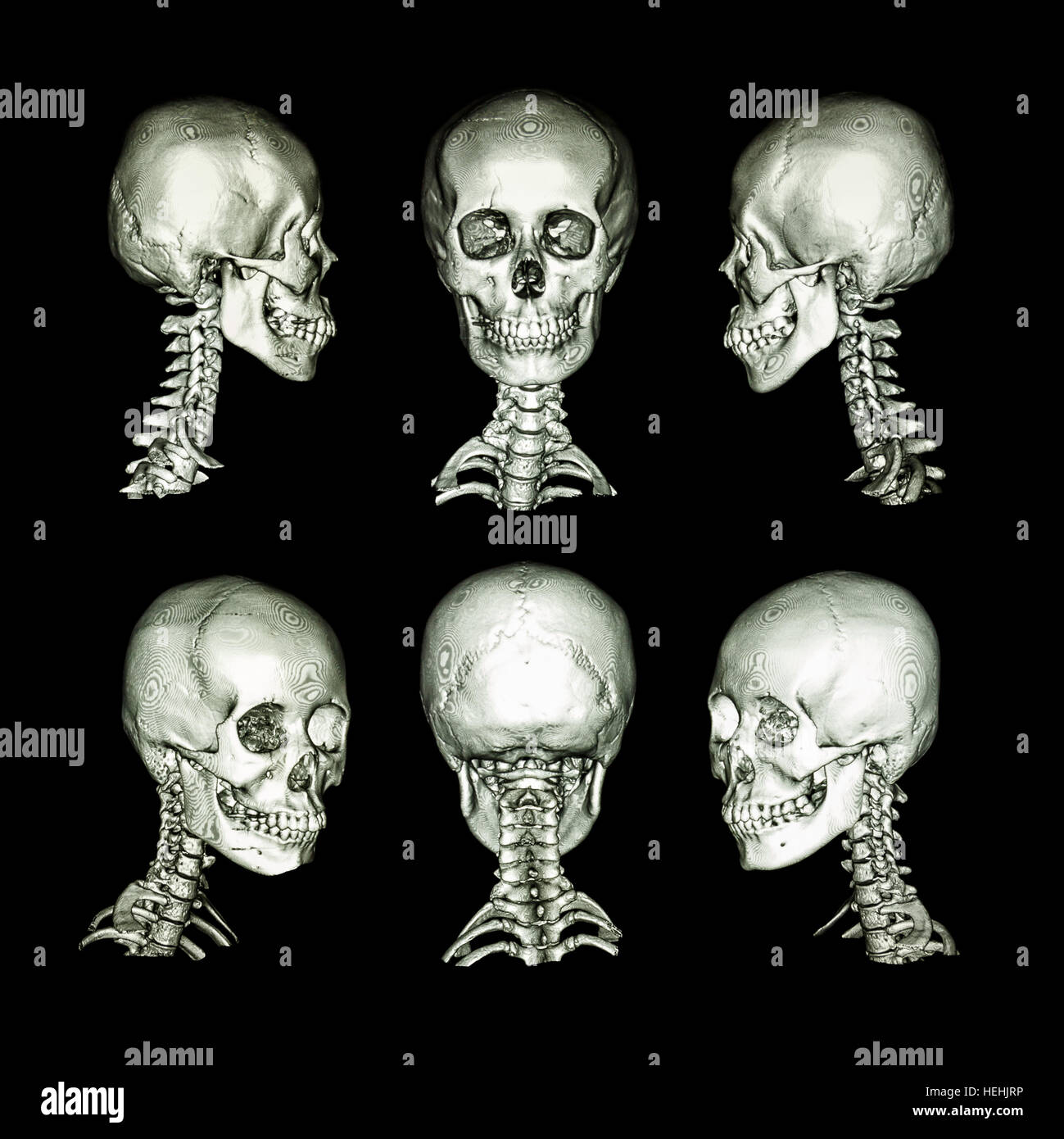 CT-Scan und 3D-Bild. Normalen menschlichen Schädel und Halswirbelsäule. alle Richtungen Stockfoto