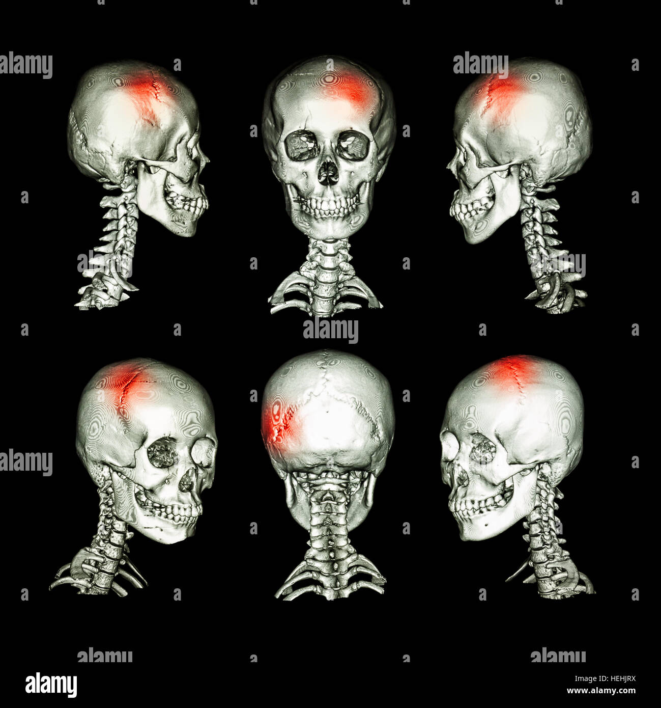 CT-Scan und 3D Bild des Kopfes und der Halswirbelsäule. Verwenden Sie dieses Bild für ...
