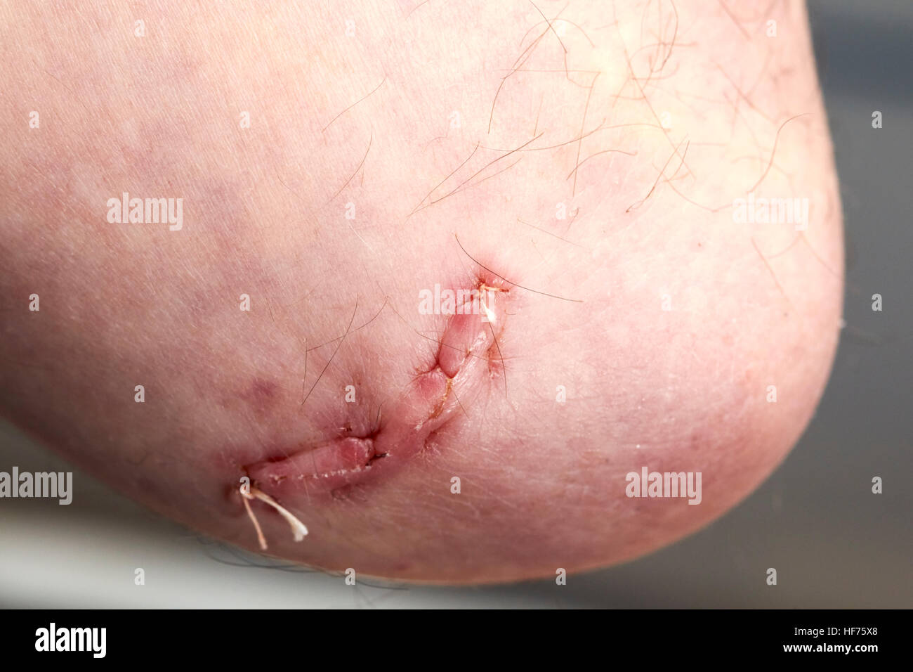 auflösbare Stiche in den Ellbogen chirurgische Wunde zu richtigen cubital Tunnel Syndrom Stockfoto