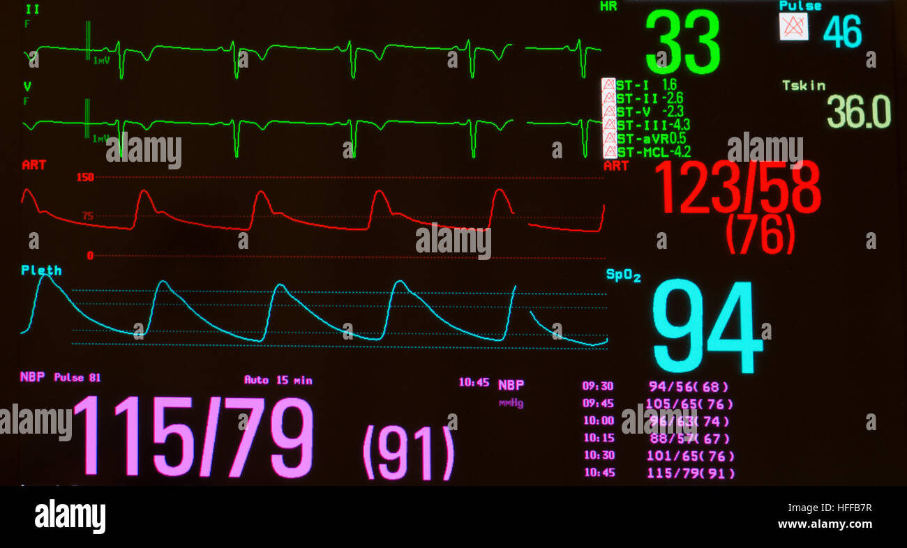 Überwachung mit EKG mit erheblichen Sinus Bradykardie, arterieller Blutdruck, Sauerstoffsättigung und nicht-invasive Blutdruck Stockfoto