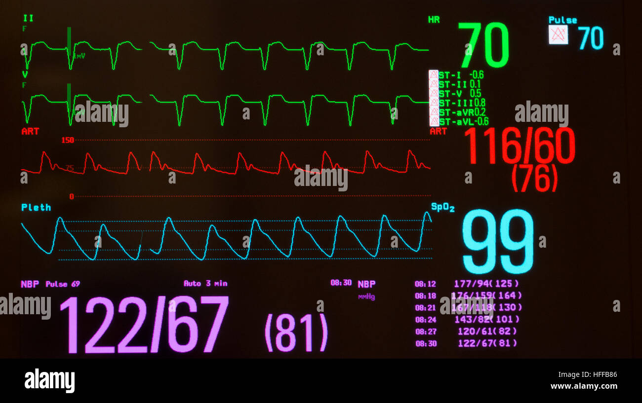 Überwachung mit EKG mit schnelllebigen Herzrhythmus, arterieller Blutdruck, Sauerstoffsättigung und nicht-invasive Blutdruck Stockfoto