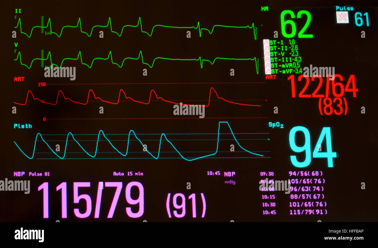 Mit Tempo Herzrhythmus zu Sinus Bradykardie, arterieller Blutdruck, Sauerstoffsättigung und nicht-invasive Blutdruck zu überwachen. Stockfoto