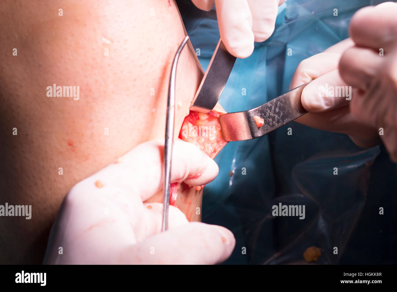 Chirurgische Operation Knie Arthroskopie Mikrochirurgie am Knie, Sehnen, Bänder und Meniskus im