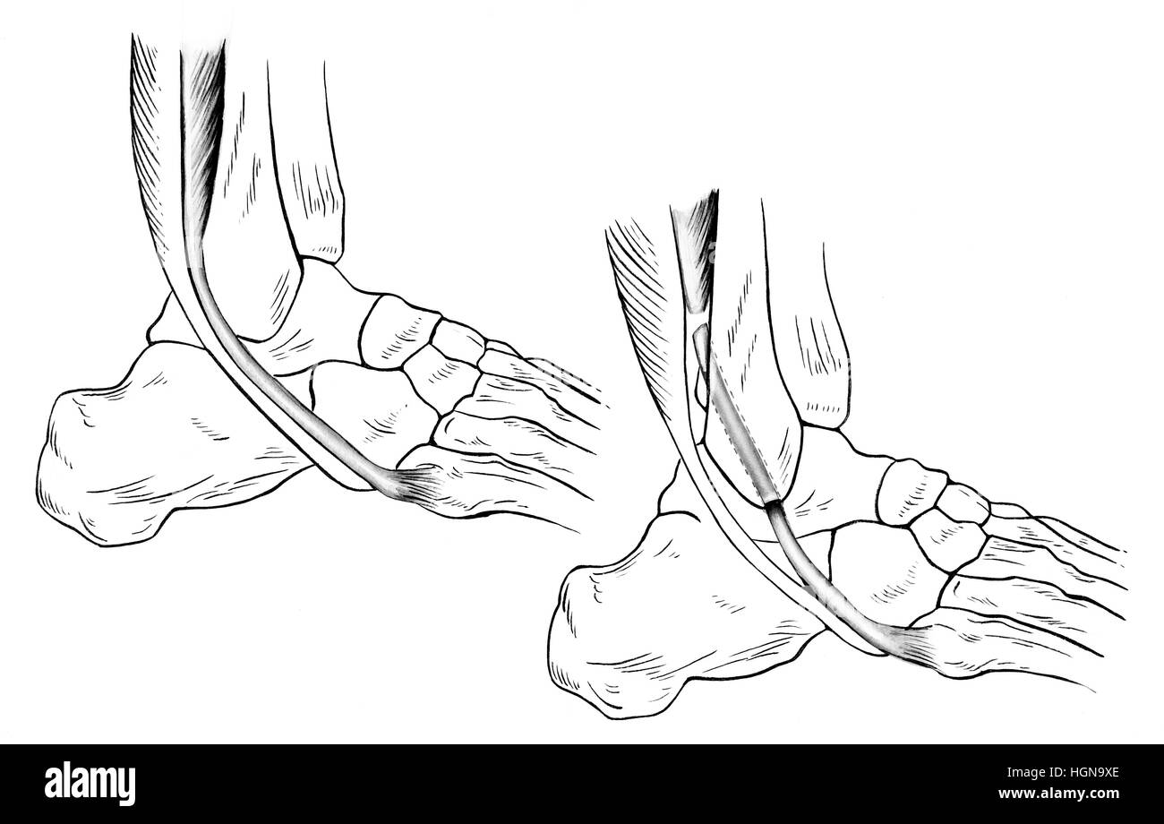 Einen verstauchten (rechts) und normal (links) Knöchel. Eine zerrissene Peronaeus Brevis Sehne wird aus seiner normalen Position nach vorne gezogen angezeigt. Stockfoto