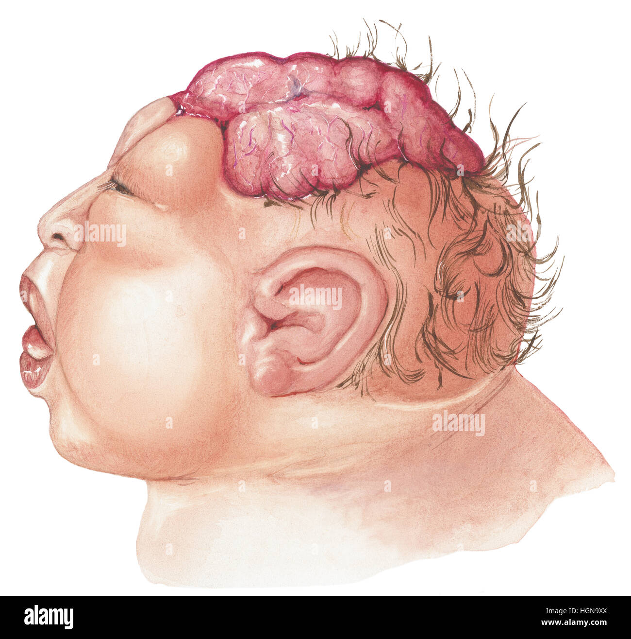 Ein neugeborenes Baby mit Anenzephalie zeigt das Gehirn durch den Schädel. Stockfoto