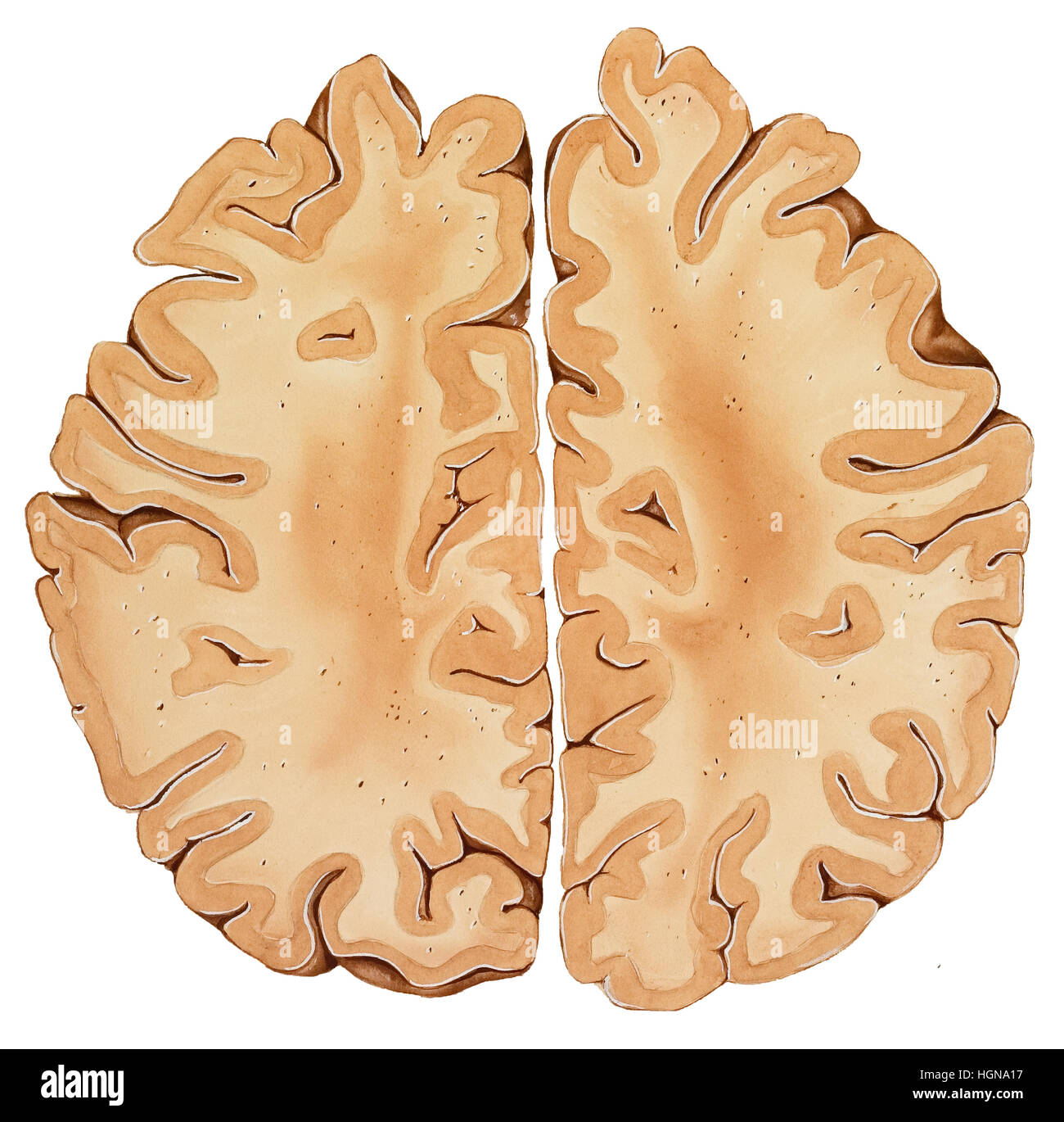 Gehirn-Abschnitt von der Spitze eines normalen menschlichen Kopfes (höhere Abschnitt), sagittale Abschnitt. Stockfoto