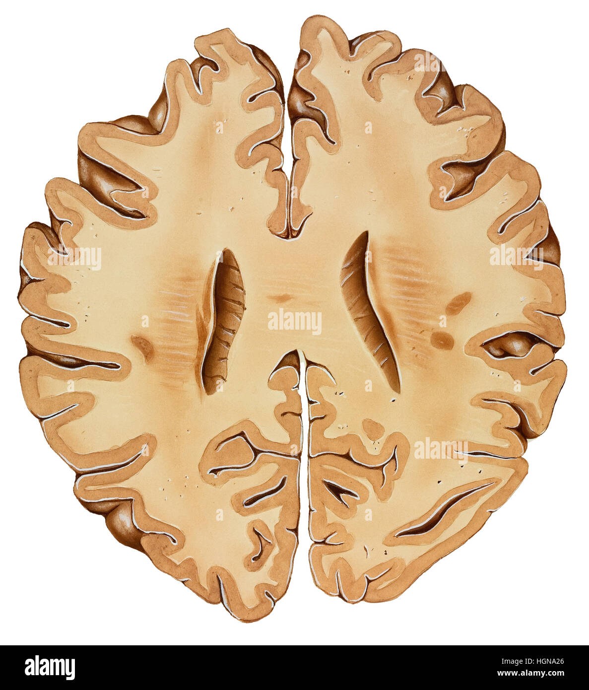 Gehirn-Abschnitt von der Spitze eines normalen menschlichen Kopfes (Unterteil), sagittale Abschnitt. Stockfoto