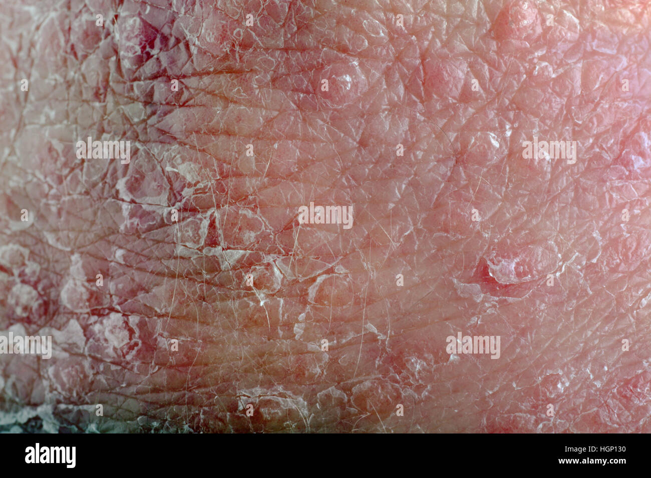 Psoriasis, Nahaufnahme Detail von Haut-Plaques zeigen. Stockfoto