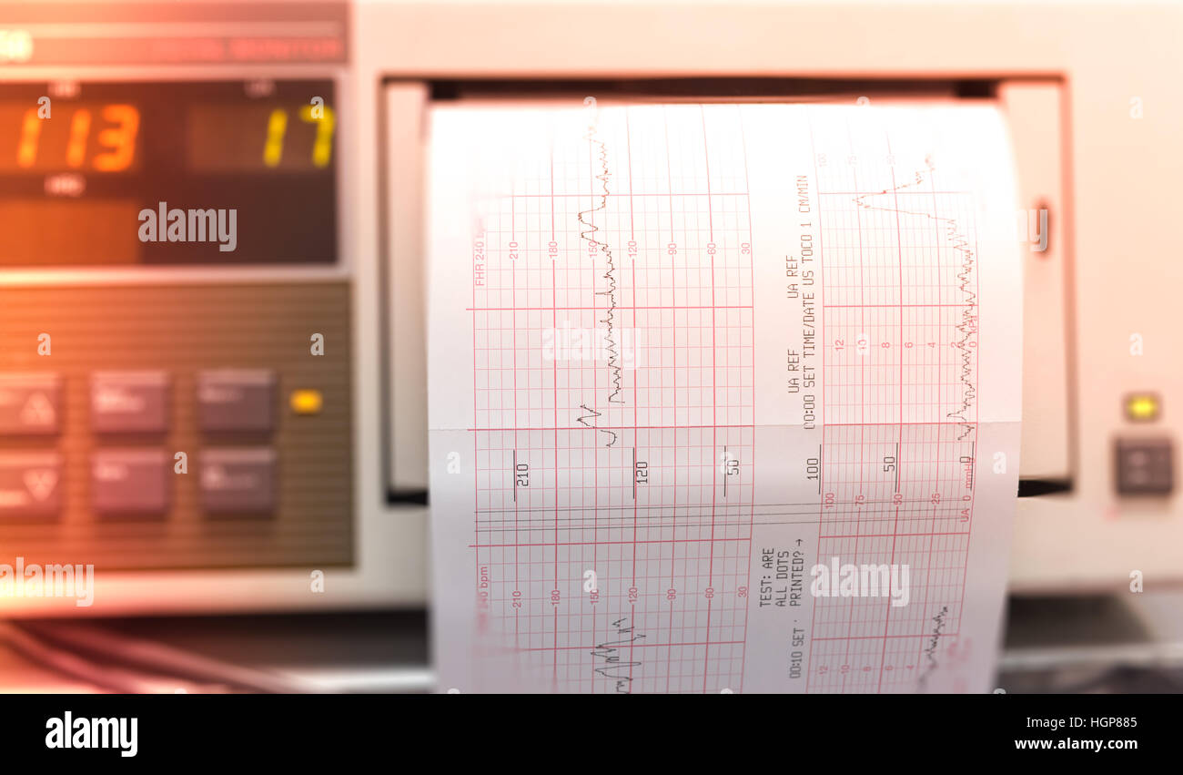 Drucken von EKG-Bericht, die sich aus EKG Iin Kreißsaal Stockfoto
