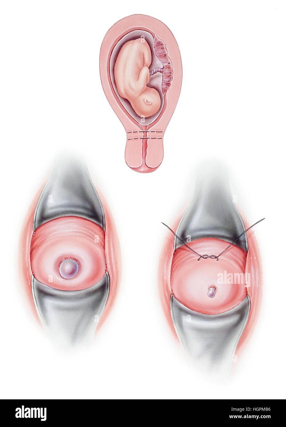 Zervikalen Cerclage, eine Operation verwendet, um einen inkompetenten Hals während der Schwangerschaft geschlossen zu halten. Bereich der Behandlung (oben), werden vor Behandlung Ansicht gezeigt Stockfoto