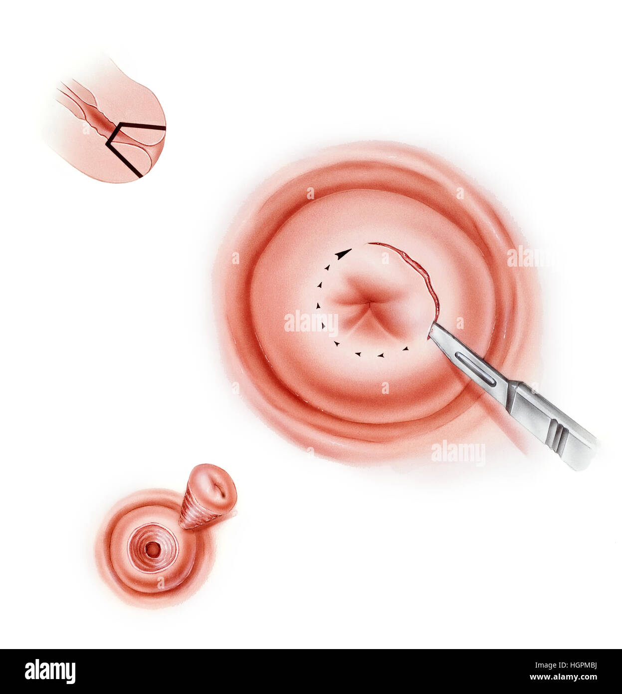 Konisation (Konisation oder kalten Messer-Konisation) des Gebärmutterhalses, ein Verfahren zur Erkennung und Behandlung von Anomalien des Gebärmutterhalses, wie zervikale n Stockfoto