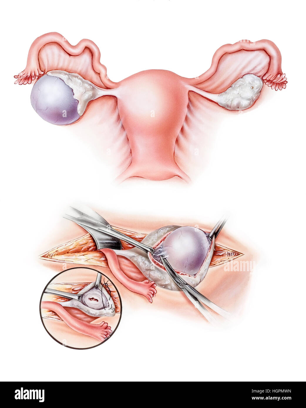 Eierstöcke - ovarielle Zystektomie chirurgische Entfernung eine Ovarialzyste. Gezeigt werden eine Ovarialzyste im linken Eierstock (oben), Dissektion der Zyste aus der ova Stockfoto