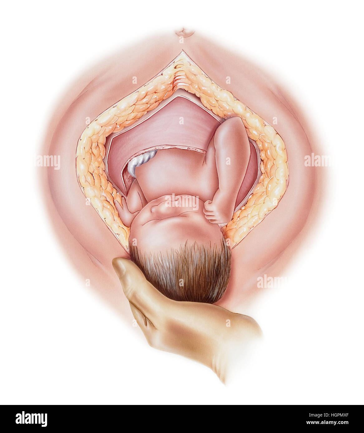 Schwangerschaft - Kaiserschnitt (c-) Abschnitt Geburt, in denen ein Arzt das Baby durch Einschnitte in den unteren Bauch und Gebärmutter liefert. Stockfoto
