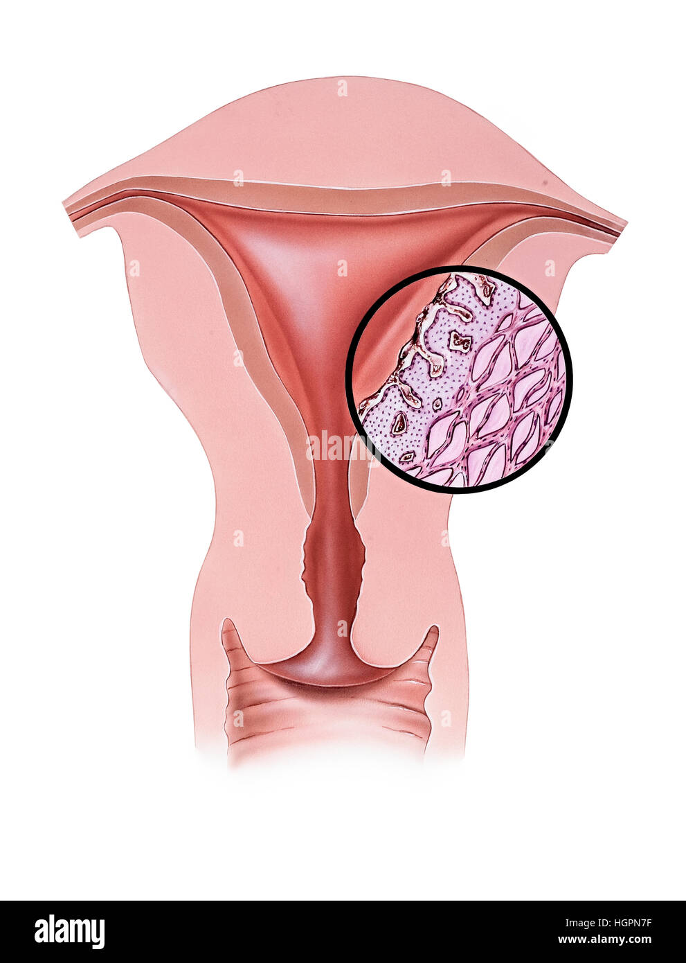 Konzeptionelle Darstellung der Dysmenorrhoe (Menstruationsschmerzen). Primäre Dysmenorrhoe tritt auf, wenn Jus Prostaglandine synthetisiert in der Gebärmutterwand aufbauen Stockfoto