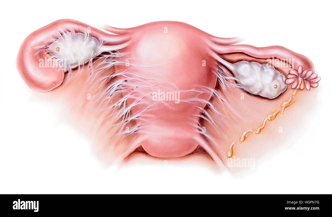 Gebärmutter - Adnexitis (PID) Stockfoto