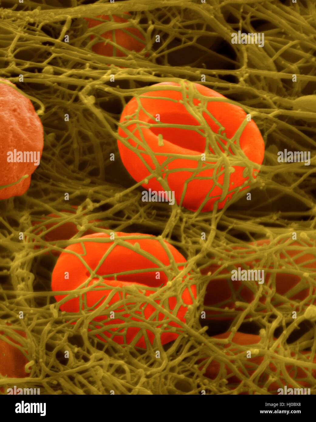 Menschlichen Erythrozyten in Fibrin Blutgerinnsel, farbige scanning Electron Schliffbild (SEM) gefangen. Menschlichen Erythrozyten in Fibrin Blutgerinnsel gefangen. Thrombozyten (nicht gesehen) sind Zellfragmente im Blut, die entscheidende Rolle in der Blutgerinnung Wunde Reparatur, und können auch bestimmte Immunsystem aktivieren Stockfoto