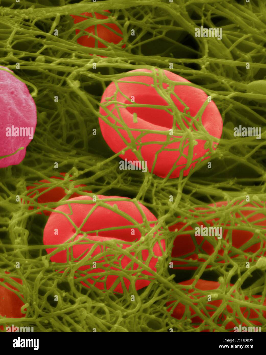 Menschlichen Erythrozyten in Fibrin Blutgerinnsel, farbige scanning Electron Schliffbild (SEM) gefangen. Menschlichen Erythrozyten in Fibrin Blutgerinnsel gefangen. Thrombozyten (nicht gesehen) sind Zellfragmente im Blut, die entscheidende Rolle in der Blutgerinnung Wunde Reparatur, und können auch bestimmte Immunsystem aktivieren Stockfoto