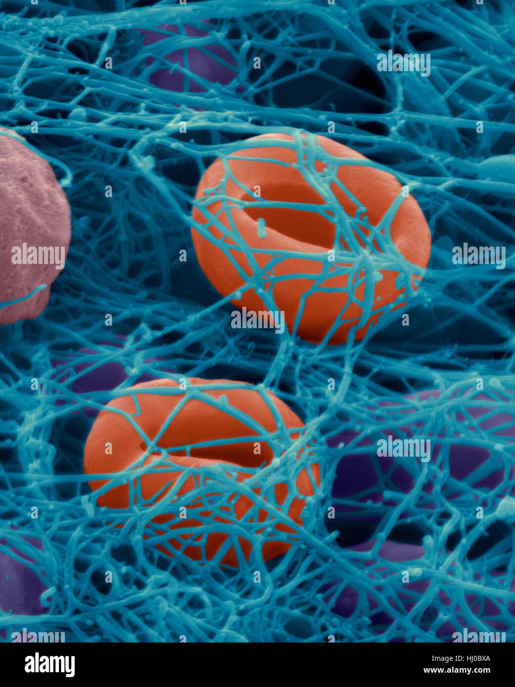 Menschlichen Erythrozyten in Fibrin Blutgerinnsel, farbige scanning Electron Schliffbild (SEM) gefangen. Menschlichen Erythrozyten in Fibrin Blutgerinnsel gefangen. Thrombozyten (nicht gesehen) sind Zellfragmente im Blut, die entscheidende Rolle in der Blutgerinnung Wunde Reparatur, und können auch bestimmte Immunsystem aktivieren Stockfoto