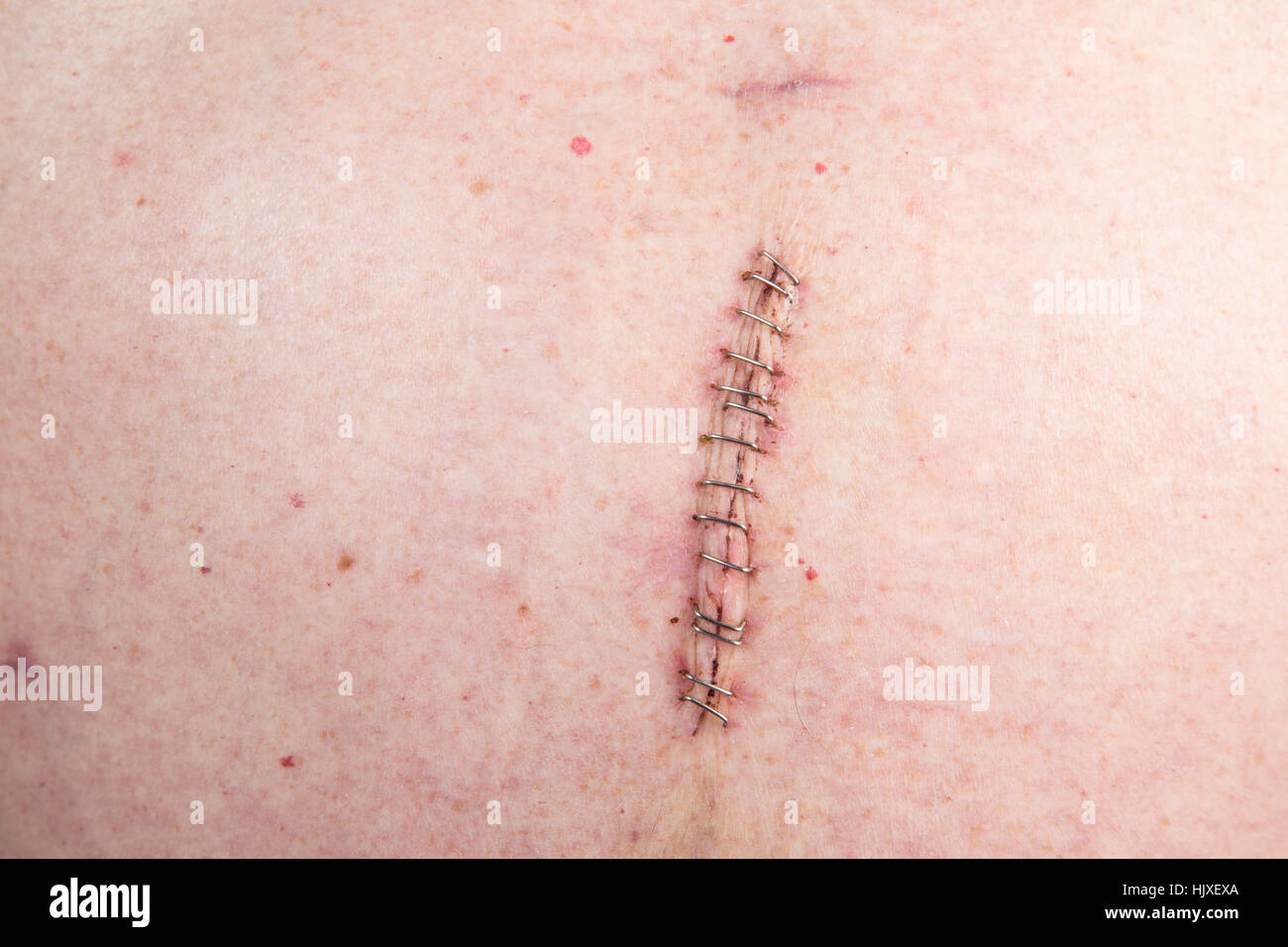 Geheftete Wunde nach Magenbypass Hernienchirurgie Stockfoto