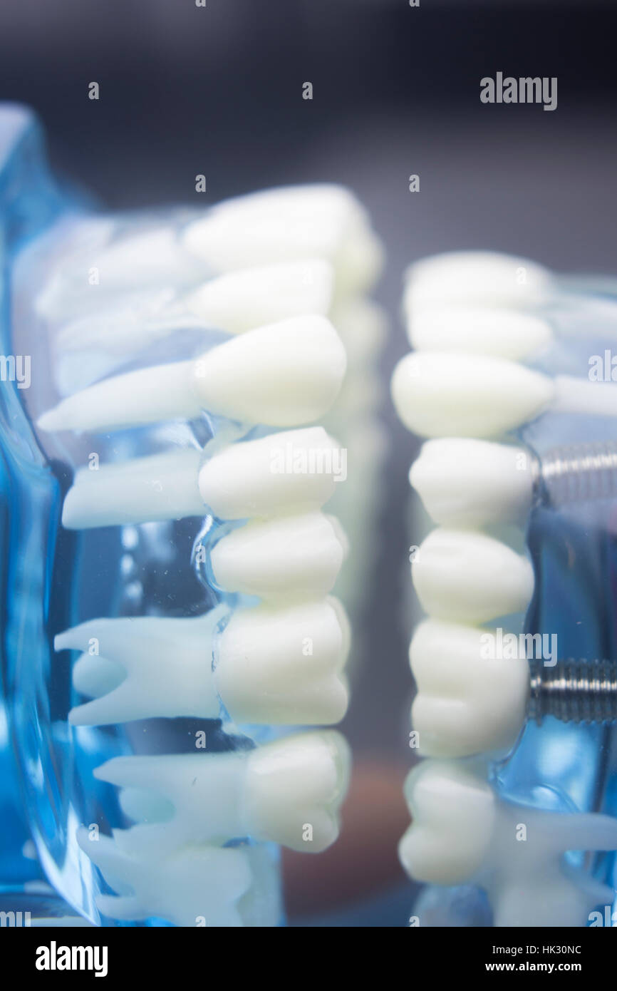 Dental Zahn Zahnmedizin Lernerfolge Lehrmodell zeigt Titan Metall ...