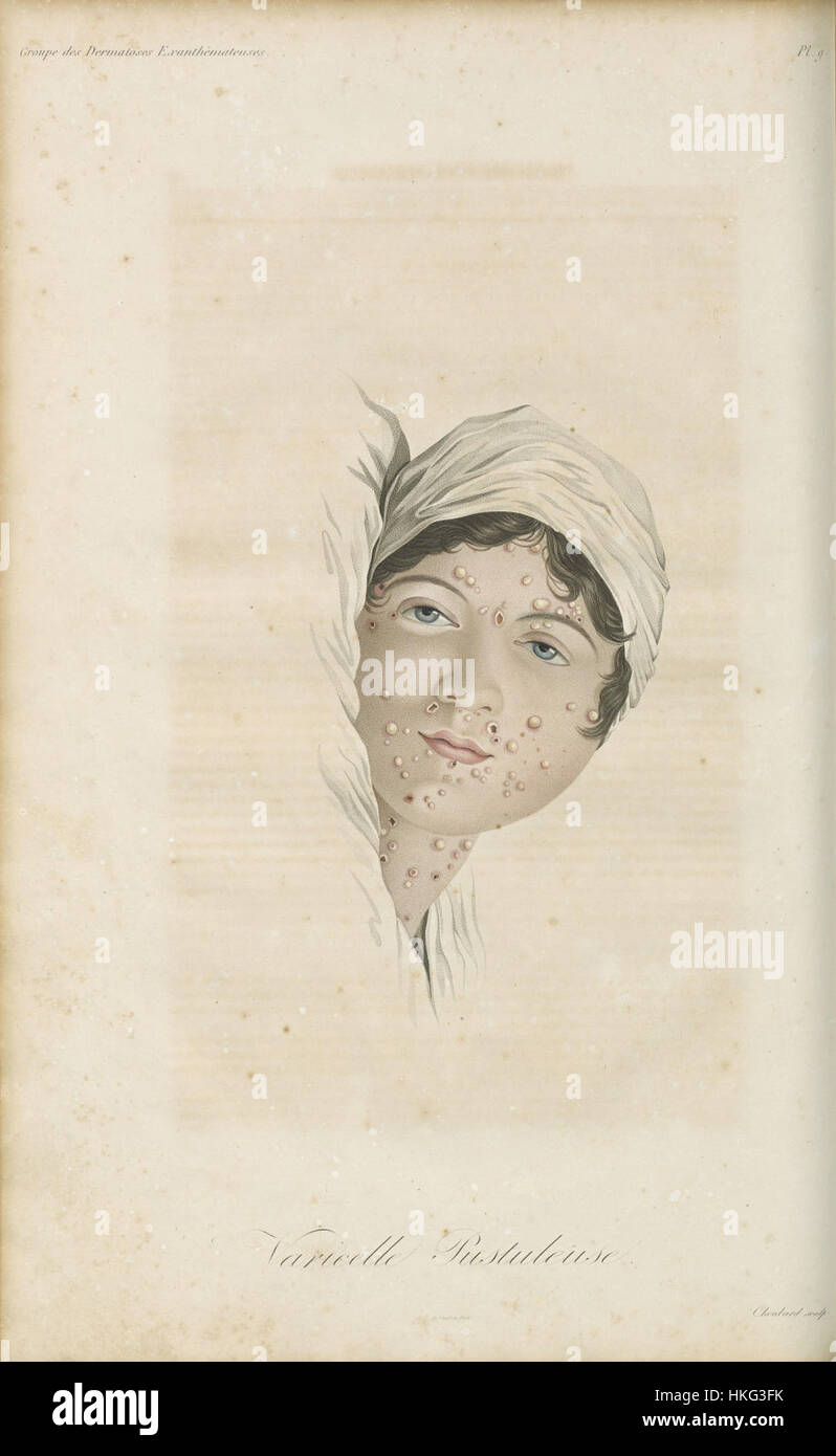 Dieses Kunstwerk von Alibert zeigt *Varicelle pustuleuse* (Pockenpusteln) und zeigt die medizinischen Illustrationen des frühen 19. Jahrhunderts. Alibert war bekannt für seine detaillierten und genauen Darstellungen von Krankheiten und deren Auswirkungen auf den menschlichen Körper. Stockfoto