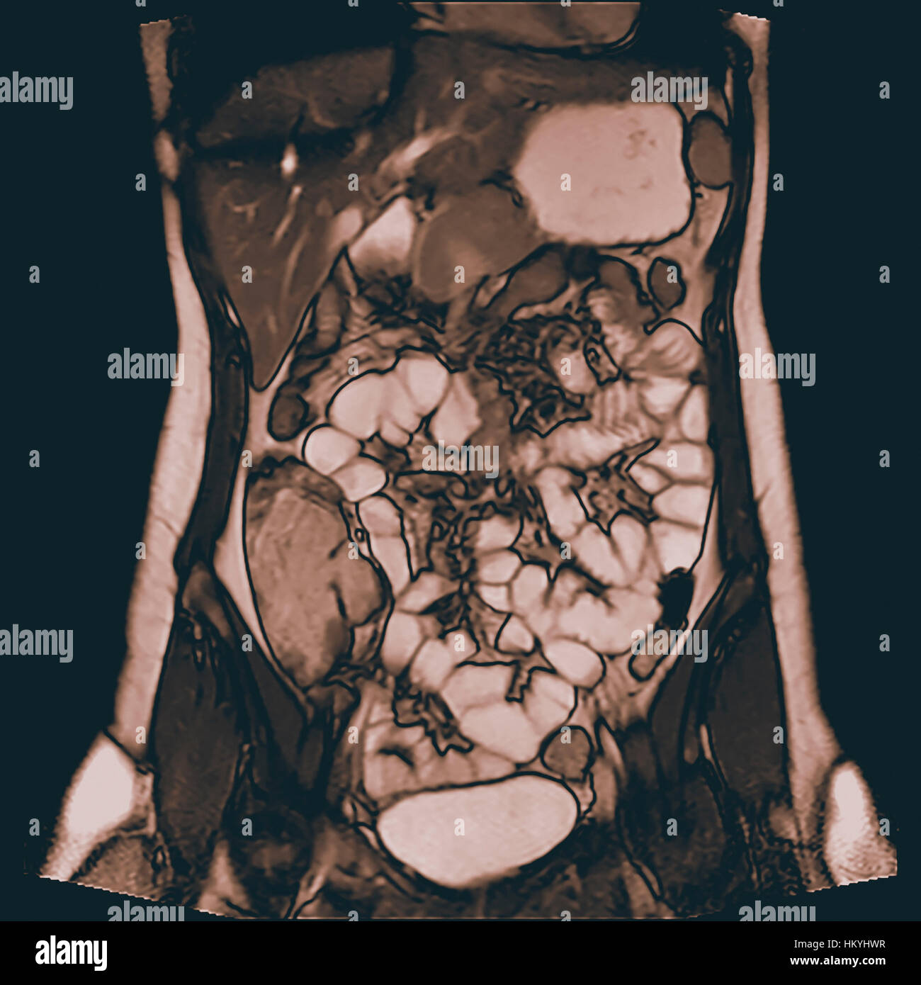 Enterography auch eine Magen-Darm-Studie oder Kontrast Radiographie des Magen-Darm-Trakt, genannt ist eine Serie von Röntgenaufnahmen t untersucht Stockfoto