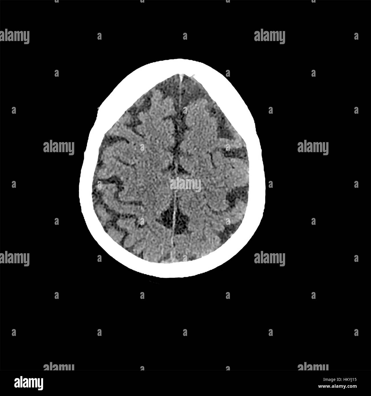 Kopf CT scan eines 85 Jahre alten weiblichen Patienten mit Anzeichen von Demenz Stockfoto