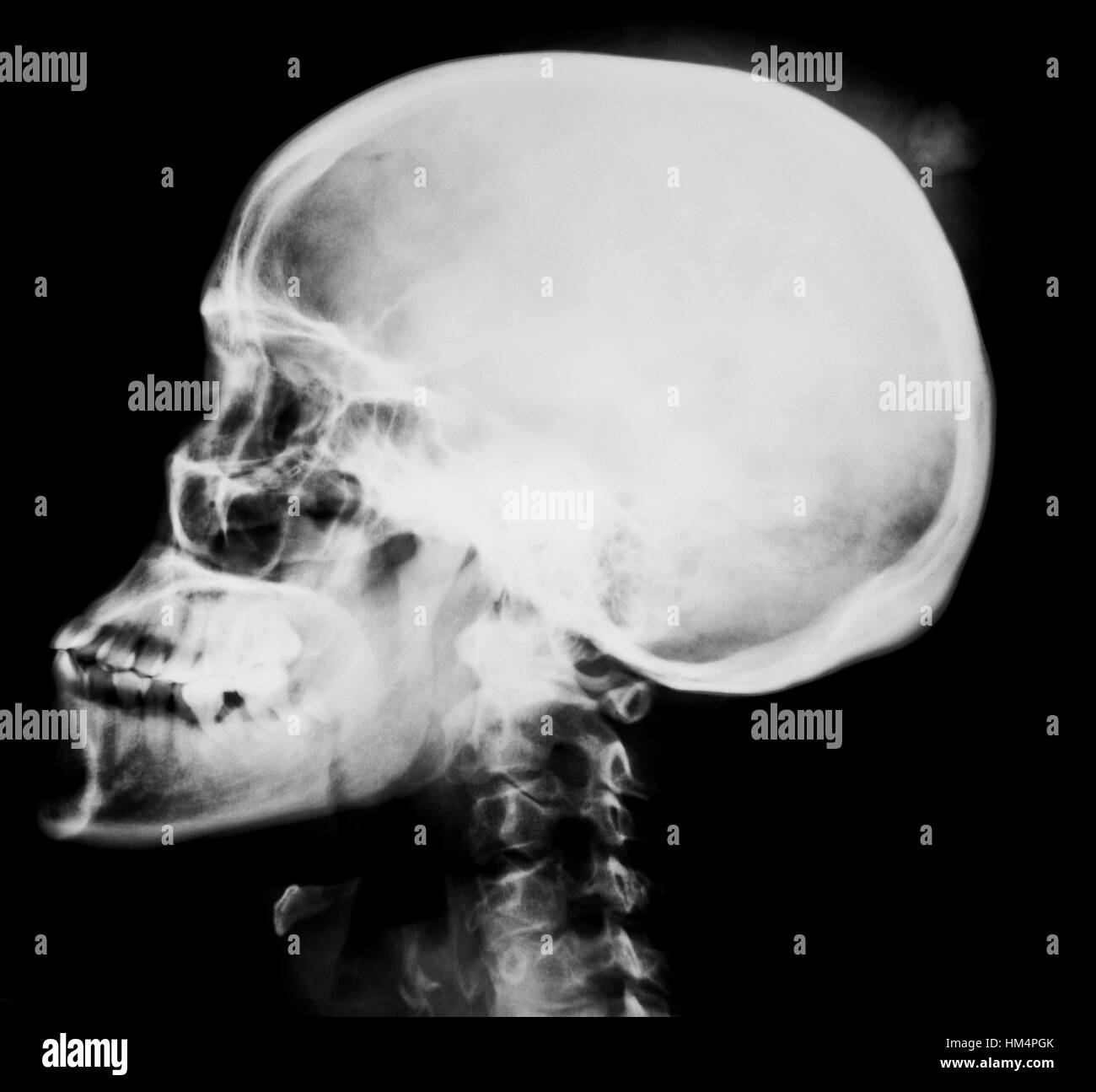 Menschlichen Kopf Röntgenfilm Stockfoto