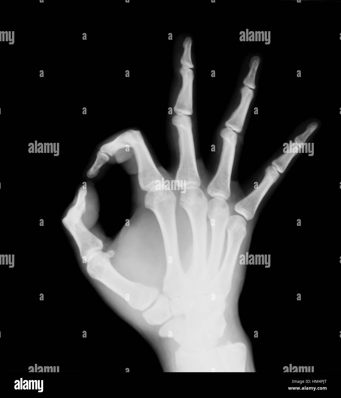X-ray sowohl menschliche Hand (OK!) Stockfoto