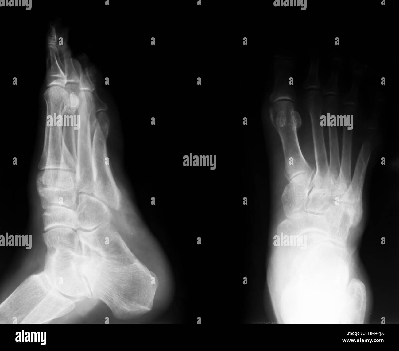 Röntgen der beiden menschlichen Füße Stockfoto