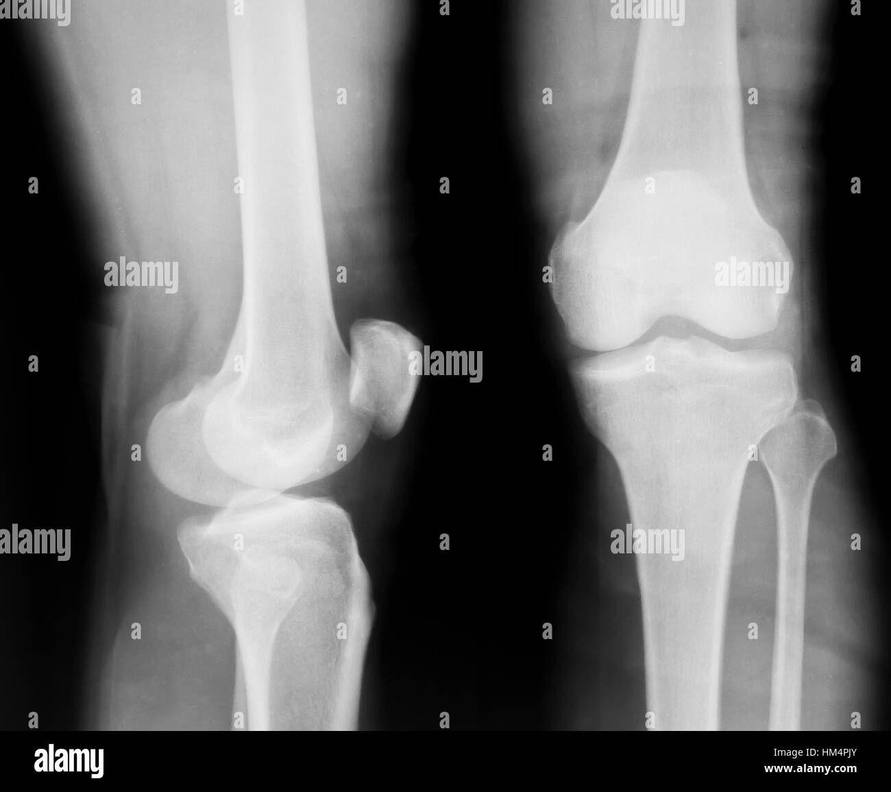 Röntgen der beiden menschlichen Knie Stockfoto