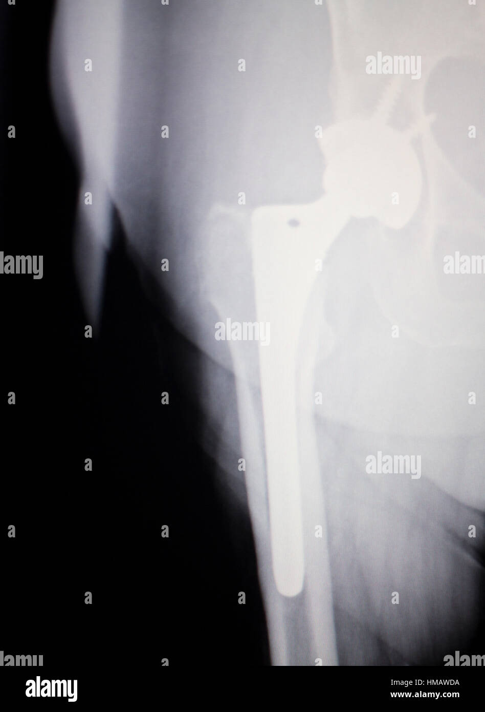 Hüftgelenk Ersatz Xray mit Ball und Socket Joint Titanschraube Implantat in medizinischen Orthpodedics Scan. Stockfoto