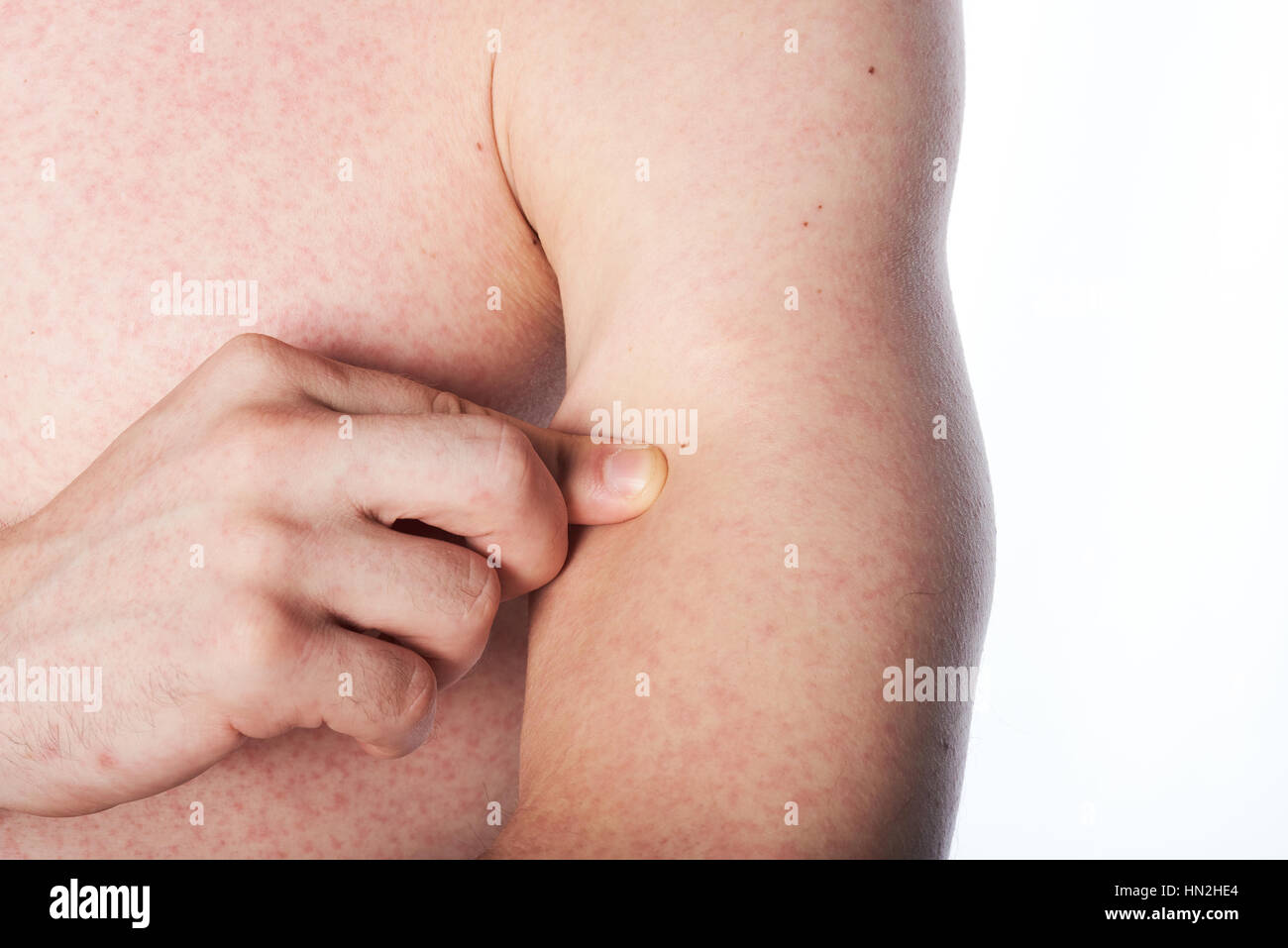 Mann mit juckender Haut kratzen seiner hand Stockfoto