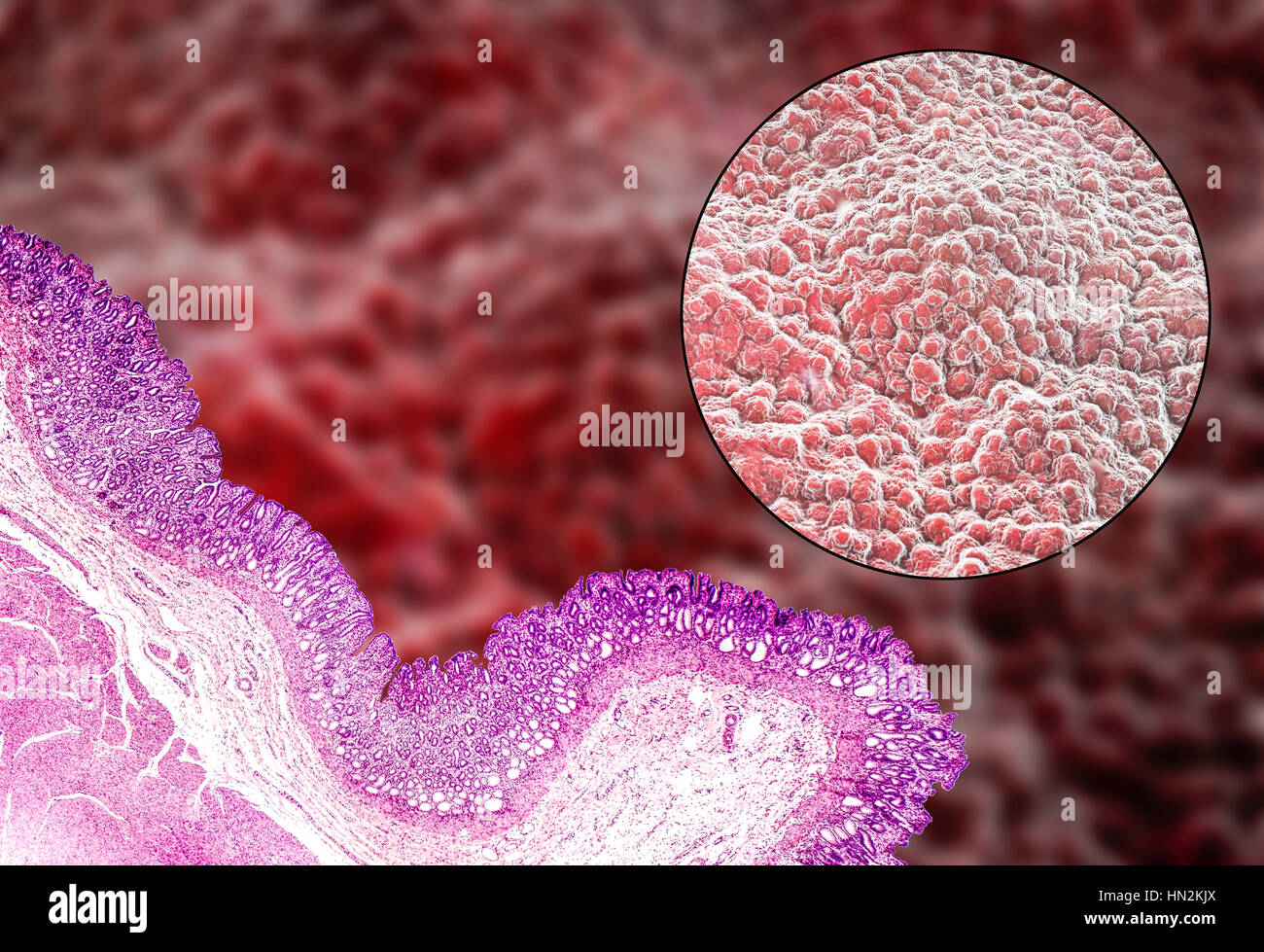 Magen-Schleimhaut. Leichte Schliffbild (unten links) und Computer Bild (oben rechts) von der Schleimhaut des Magens, bekannt als die Schleimhaut. Der Magen ist ein muskulöser Sac Lagerung und Verdauung der Nahrung beteiligt. Die Oberfläche der Schleimhaut besteht aus einfachen säulenartigen Zellen (dunkelviolett im Schliffbild), die Schleim absondern. Der Schleim schützt die Magenschleimhaut vor Verdauung Säuren und Enzyme, die auf Nahrung im Magen wirken. Unter die säulenartigen Zellen sind gastrische Gruben, die Drüsen, aus denen die Säuren und Enzyme notwendig, um Nahrung zu verdauen. Stockfoto