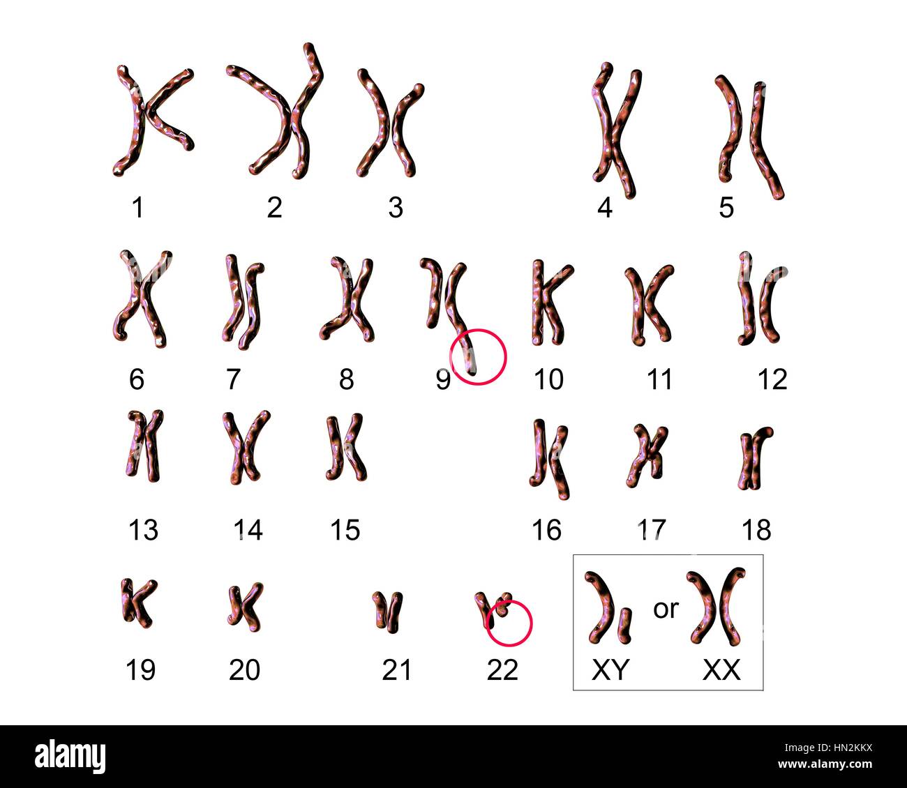 Philadelphia chromosome.Computer Darstellung der männlichen oder weiblichen Chromosomen (Chromosomensatz) einen defekten Chromosom jedes von Paaren 9 (Zentrum) 22 (unten Mitte). Die Defekte verursachen auf rechten Chromosomen von zwei Paaren, chronische myeloische Leukämie (CML). Die 46 Chromosomen des Menschen Karyotyp Stockfoto