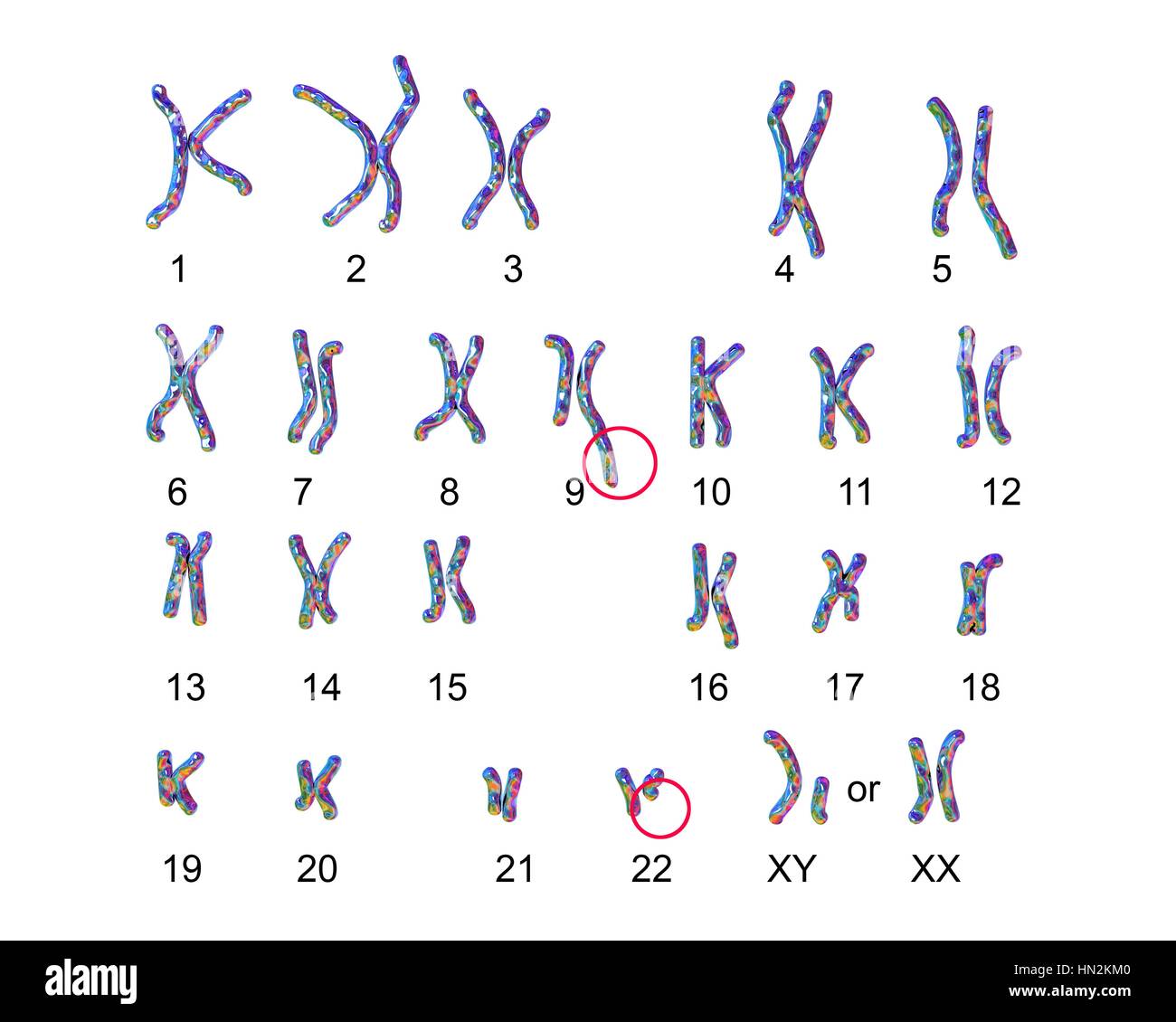 Philadelphia chromosome.Computer Darstellung der männlichen oder weiblichen Chromosomen (Chromosomensatz) einen defekten Chromosom jedes von Paaren 9 (Zentrum) 22 (unten Mitte). Die Defekte verursachen auf rechten Chromosomen von zwei Paaren, chronische myeloische Leukämie (CML). Die 46 Chromosomen des Menschen Karyotyp Stockfoto