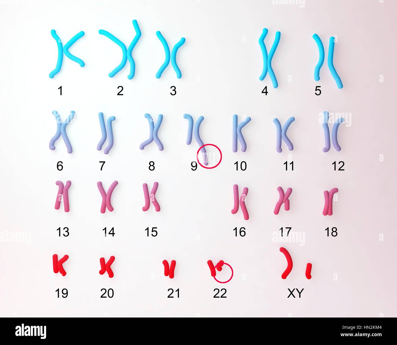 Philadelphia chromosome.Computer Darstellung der männlichen oder weiblichen Chromosomen (Chromosomensatz) einen defekten Chromosom jedes von Paaren 9 22. die Mängel am rechten Chromosomen von zwei Paaren, Ursache chronische myeloische Leukämie (CML). Die 46 Chromosomen des Menschen Karyotyp sind hier 23 paarweise angeordnet. Stockfoto