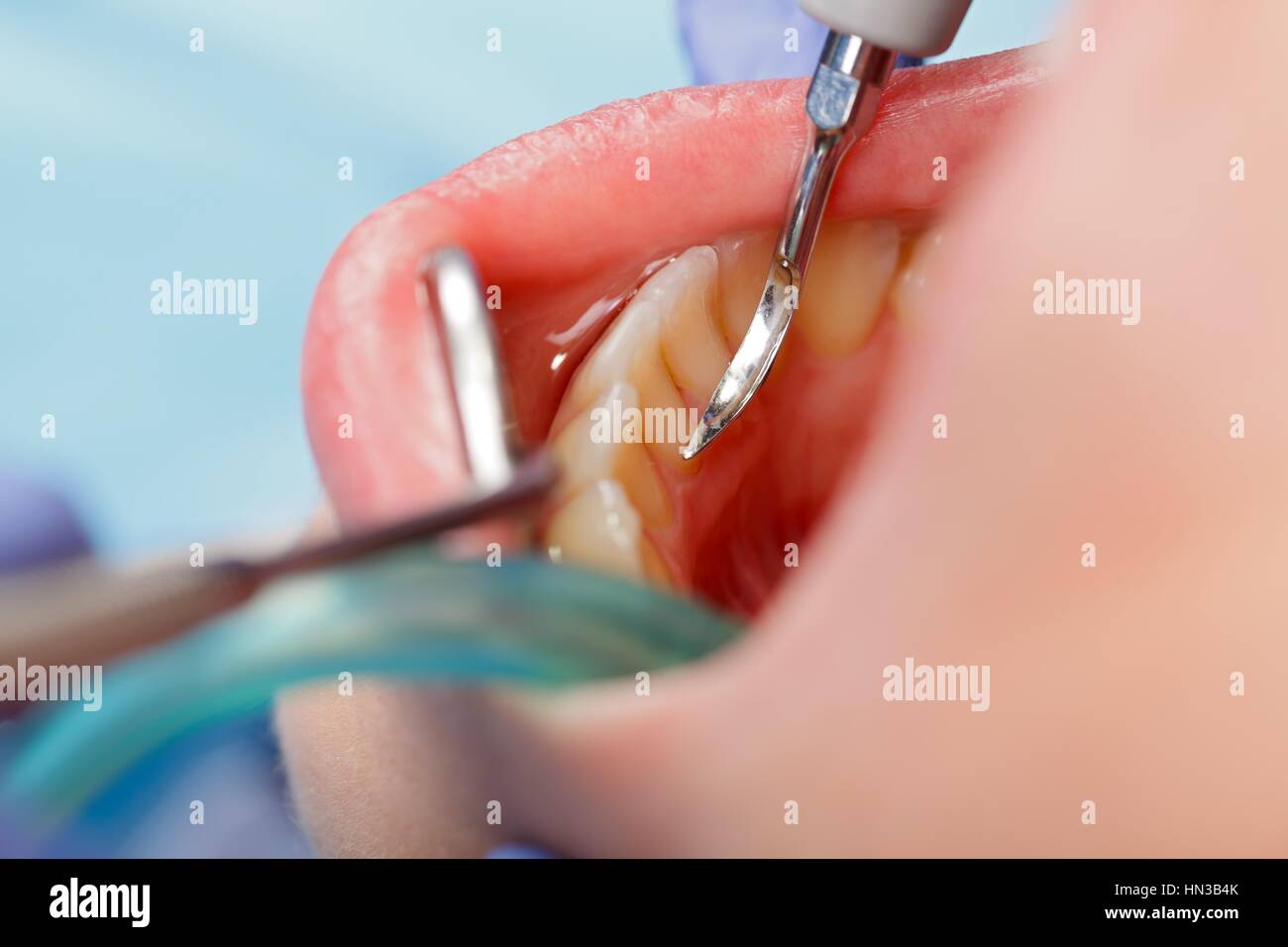 Nahaufnahme eines Zahnstein entfernen Stockfoto