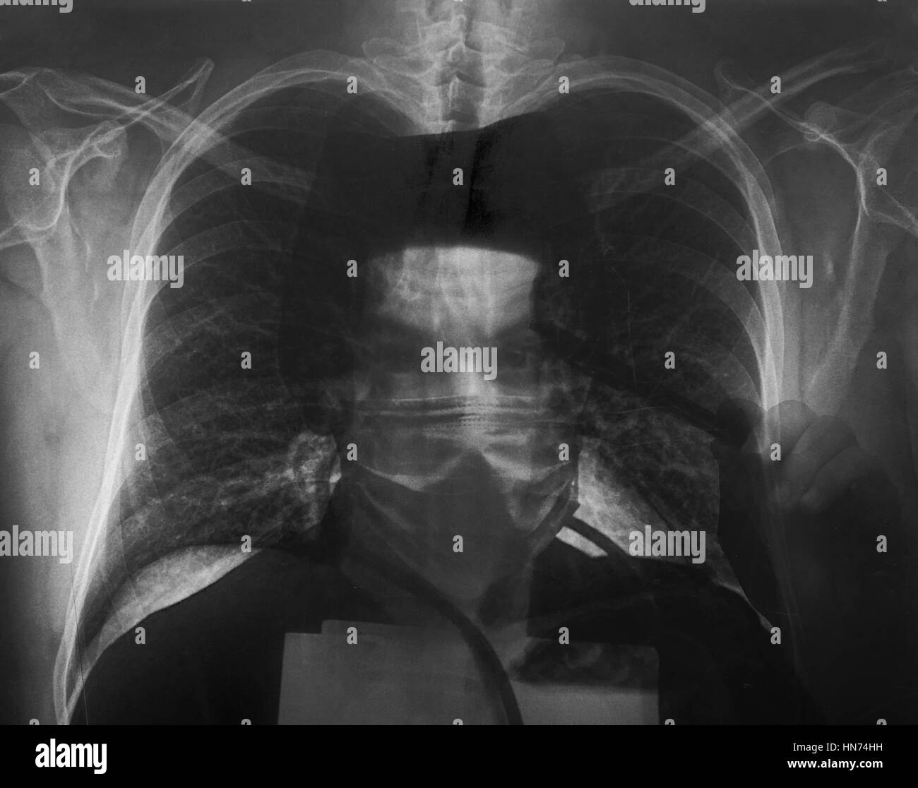 schwarz / weiß Foto von x-ray Bild Lunge mit Arzt auf Rückseite Stockfoto